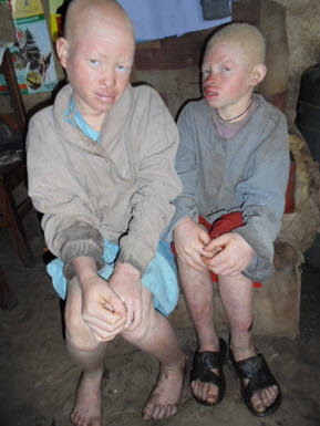 albino-children_Humanity-Healing_International